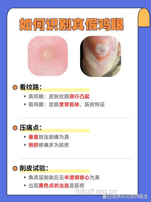 如何治疗鸡眼?