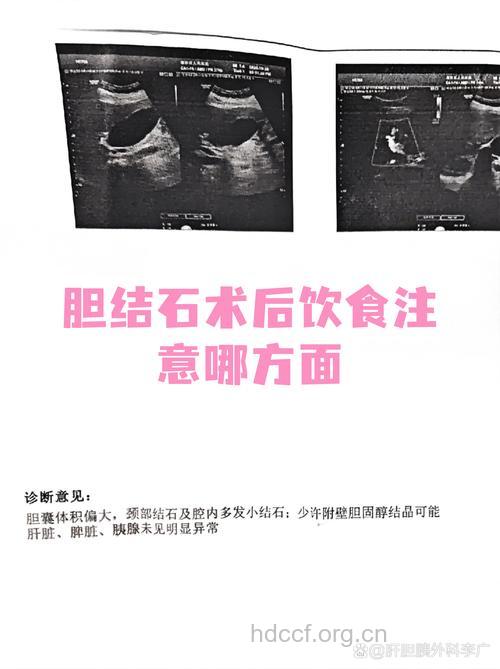 减肥过快易患胆结石 试试中医健康减肥法