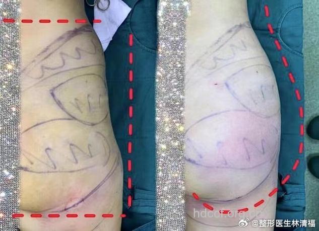 臀部反复肌肉注射 易引起臂肌挛缩症