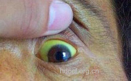 肝炎吃中药后 眼白都黄了?