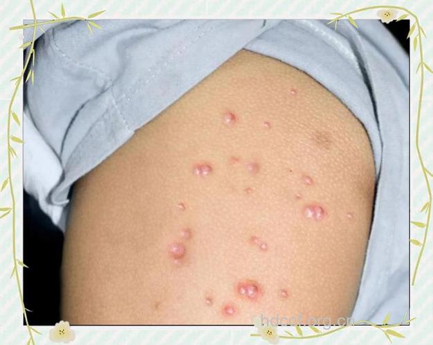 接种天花疫苗可能诱发湿疹