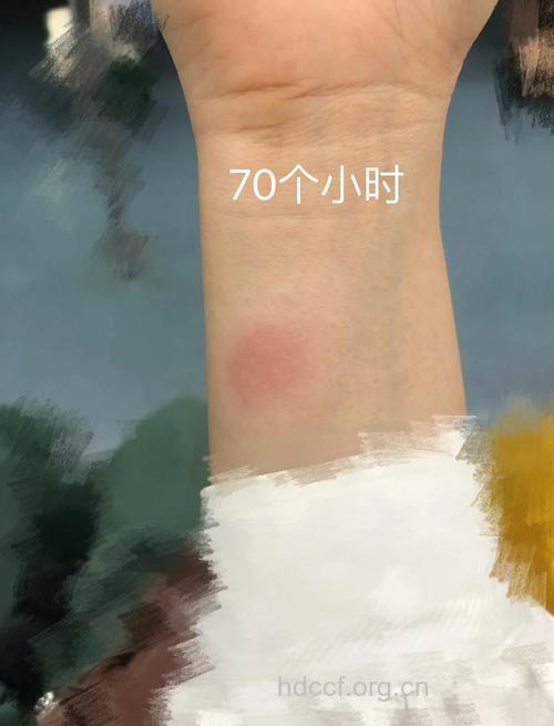 青霉素皮试阴性亦应当心