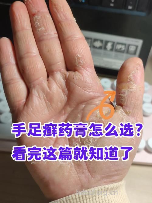 治足癣 中药杀菌止痒显身手