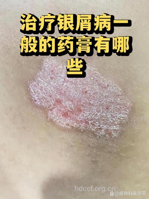 激素类药膏治疗银屑病