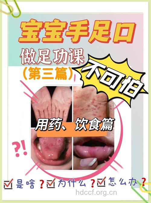 如何用中药治疗手口足病