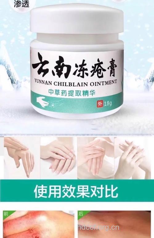 云南白药可治疗冻疮