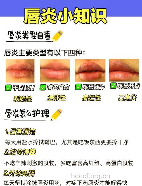 如何用药治疗口角炎