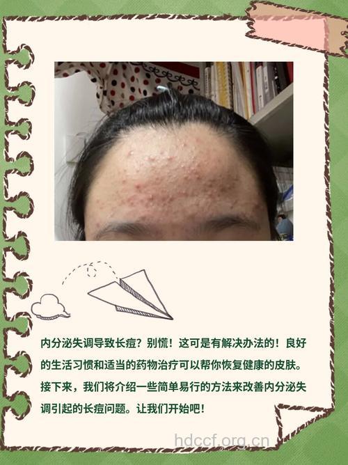 避孕药可治疗内分泌失调性青春痘?