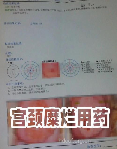 如何选择宫颈糜烂的药物？