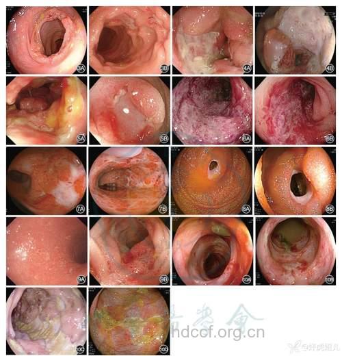 全面透视急性肠胃炎