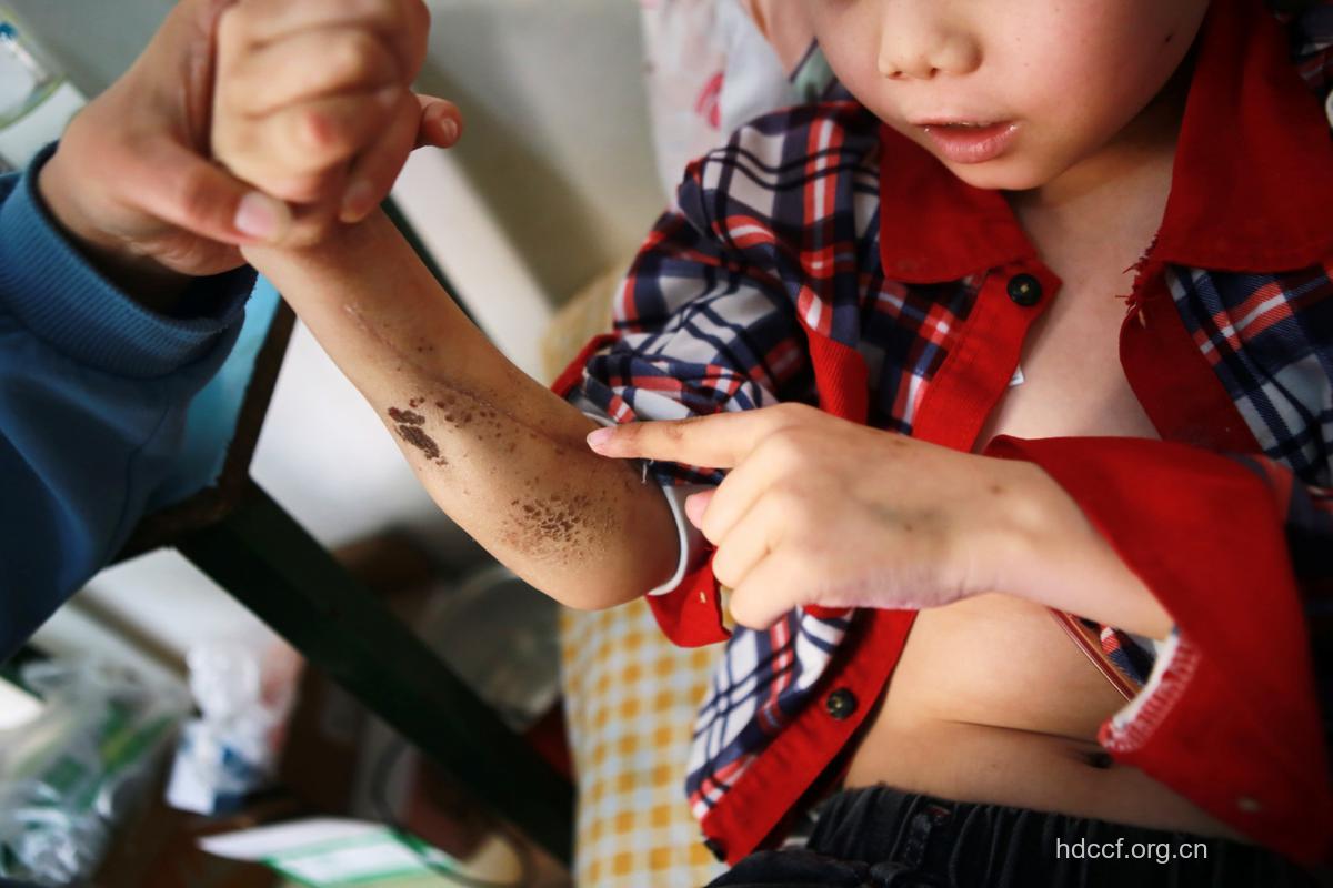 惊！幼儿涂紫药水恐致癌