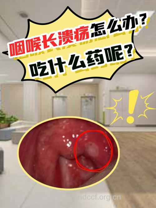 滥用润喉片致口腔溃疡、咽喉痛