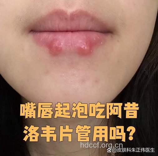 嘴角起泡 试试阿昔洛韦