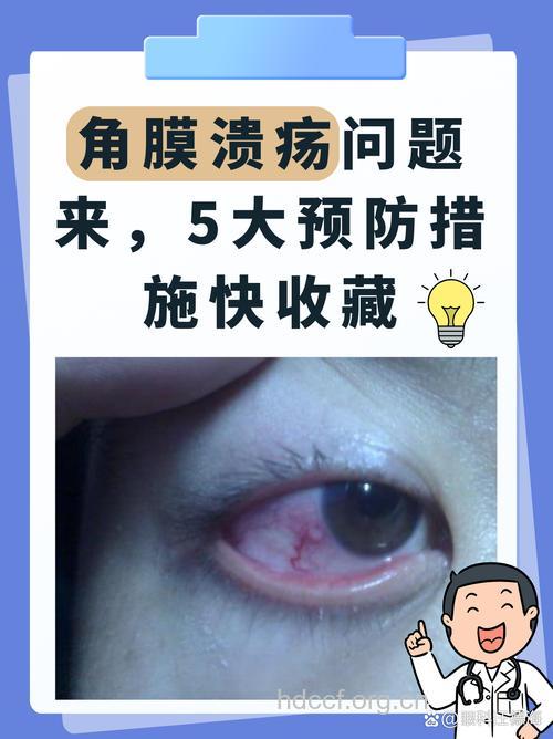 真菌性角膜溃疡如何治疗?