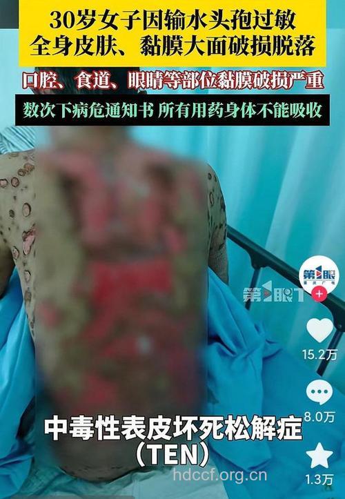 惊！药物摧毁女性容颜