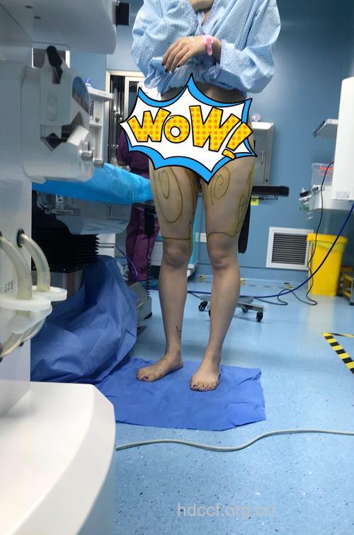 吸脂手术效果怎么样