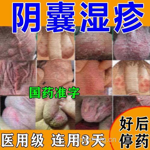 哪些药物对阴囊湿疹最有用