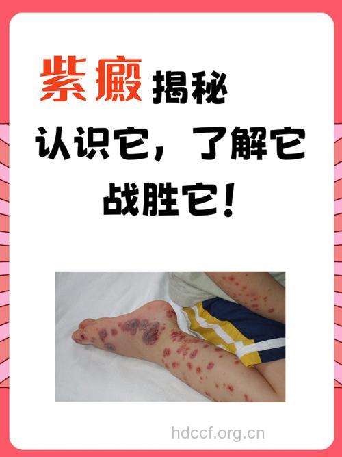 龙胆紫治疗皮肤病需谨慎