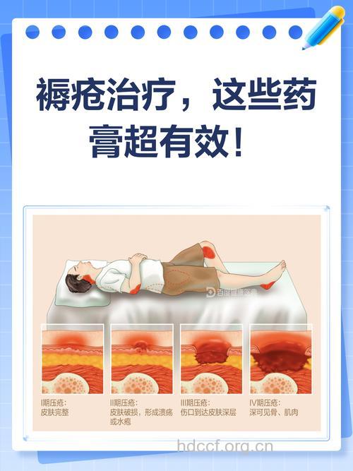 褥疮如何治疗用药最有效?