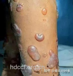 蜂蜜+庆大霉素治疗皮肤溃疡