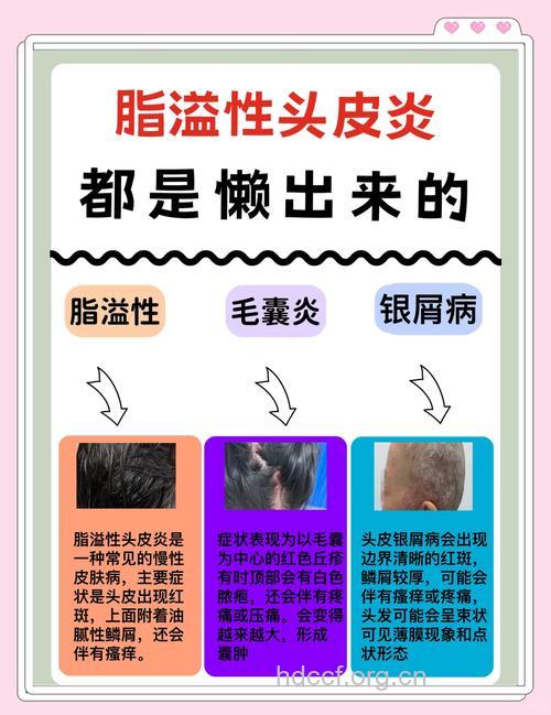 头皮屑是炎症 有了要积极治疗