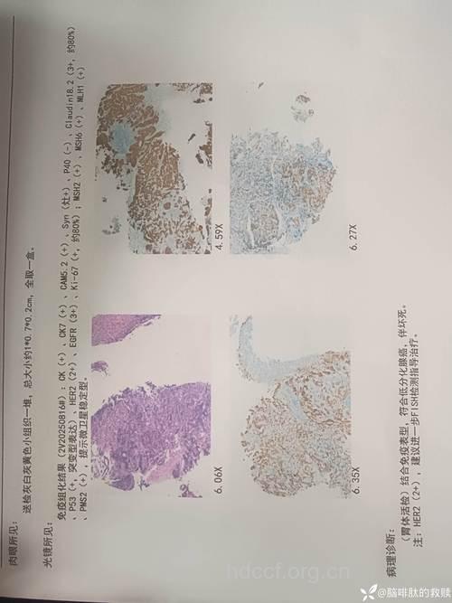 Cetrorelix后期临床实验结果