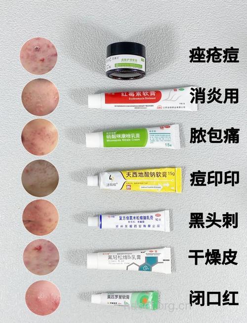 治疗面部痤疮服药的同时可用外用药