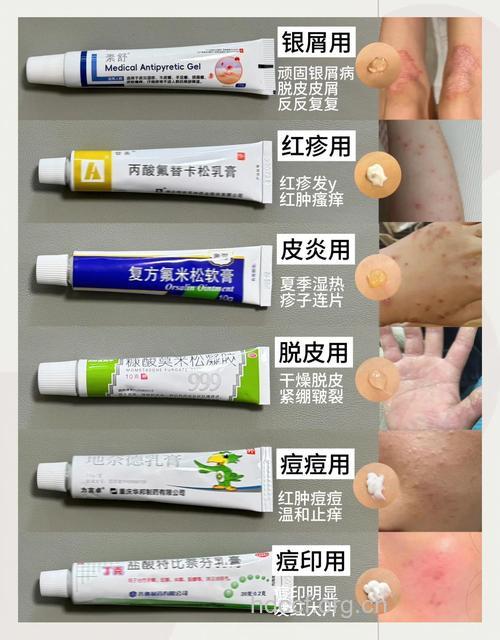 牛皮癣如何选择用药?