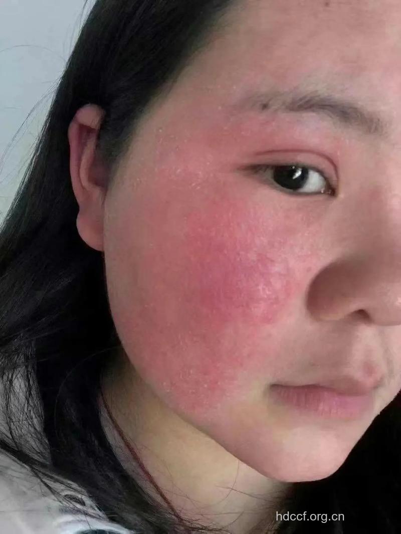 面部皮肤病 使用激素需谨慎