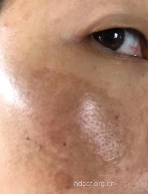 服用避孕药痘痘没了 却来了黄褐斑