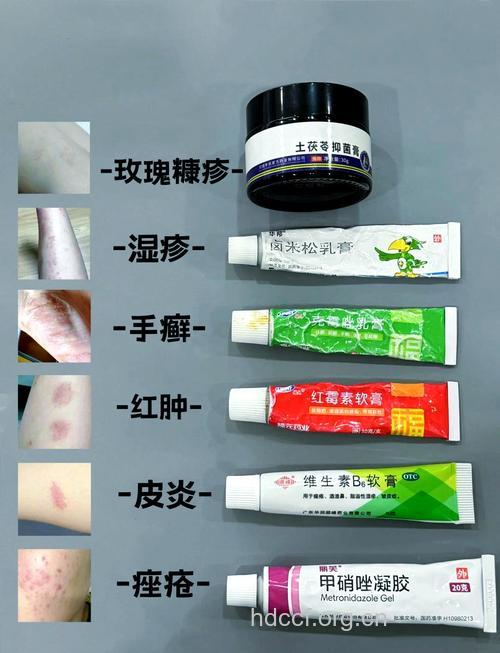 哪些皮肤病不可用激素软膏?