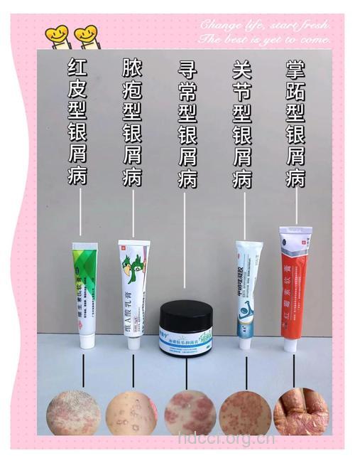 银屑病治疗外用药的注意事项