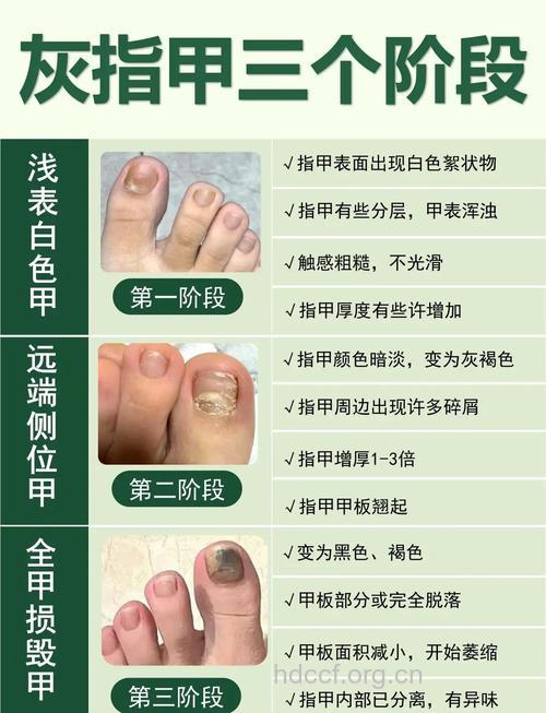 灰指甲的内外科治疗方法