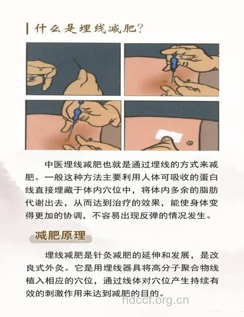穴位埋线减肥有什么优点？