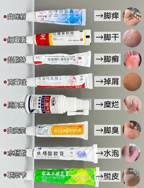 不同类型脚癣 治疗用药不同