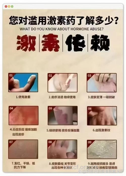 切忌滥用激素类药膏 以免加重病情