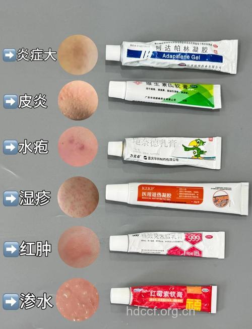 湿疹的治疗用药