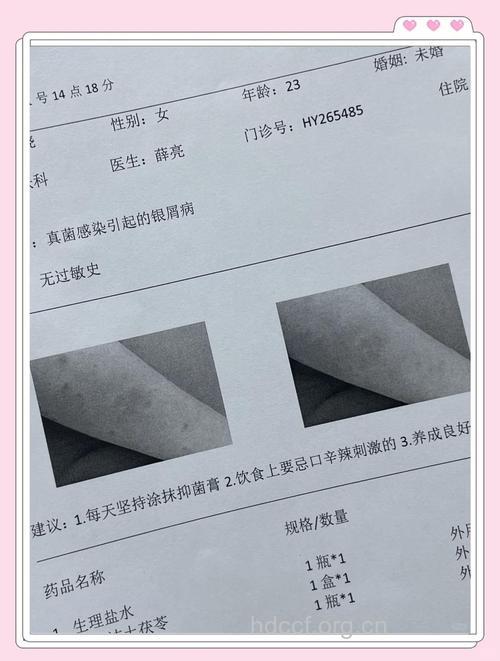 关于揭示治疗银屑病分子基础的研究
