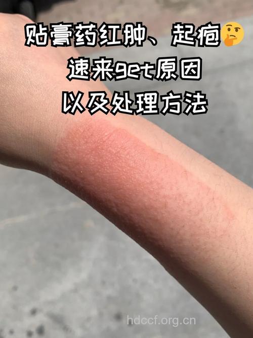 贴膏药后皮肤过敏该如何治疗?