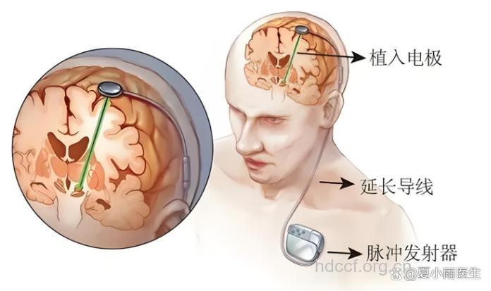 帕金森安装脑起搏器 仍需继续用药