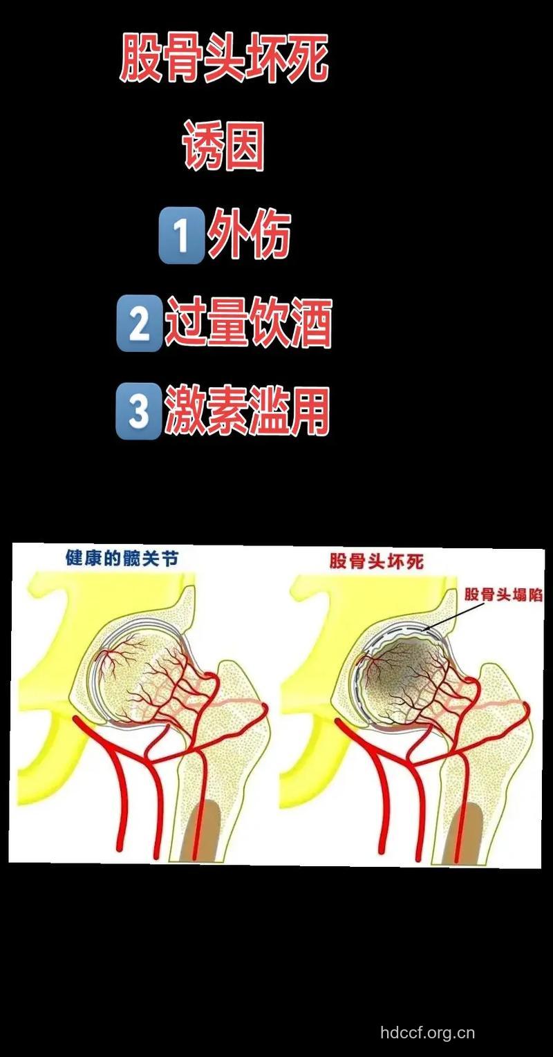 为何滥用激素导致股骨头坏死?