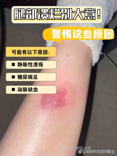 慢性皮肤溃疡 不治可能癌变