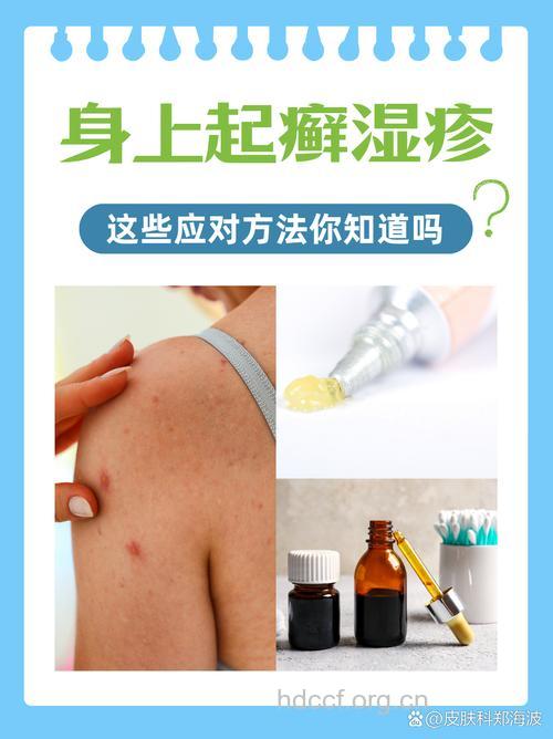真菌性皮肤病 及时治疗是真谛