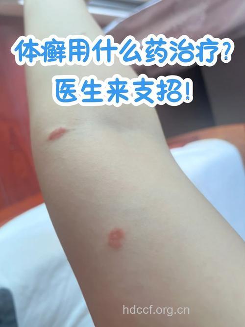 体癣治疗用药注意事项