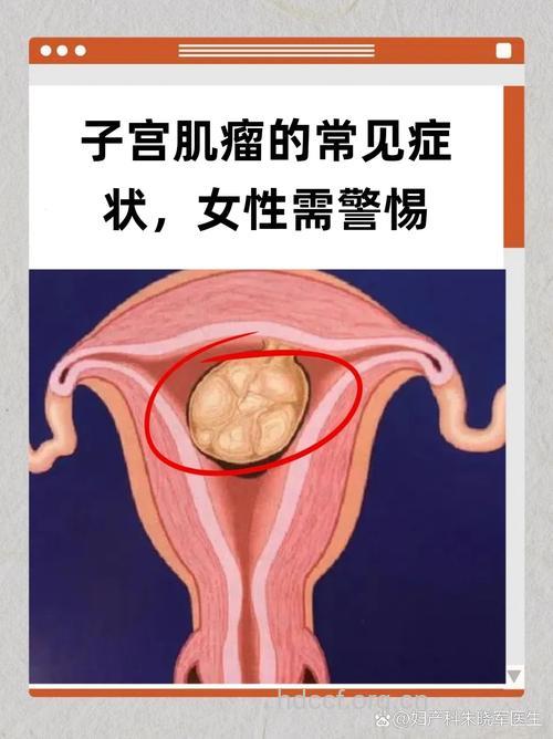 35岁以上女性 每5人有1得子宫肌瘤