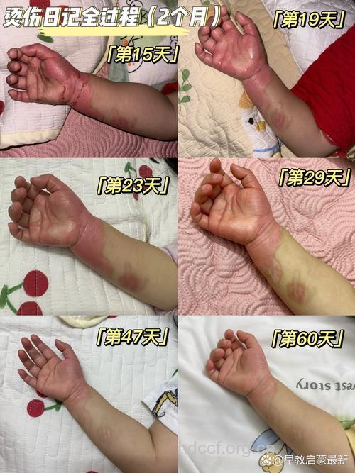 网友晒烫伤自行治疗经历