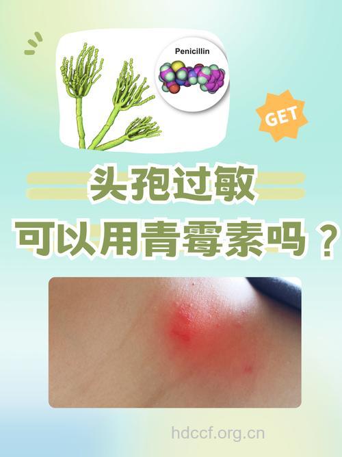 青霉素过敏患者可使用头孢类吗