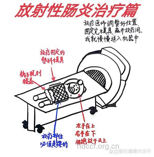 放射性直肠炎治疗