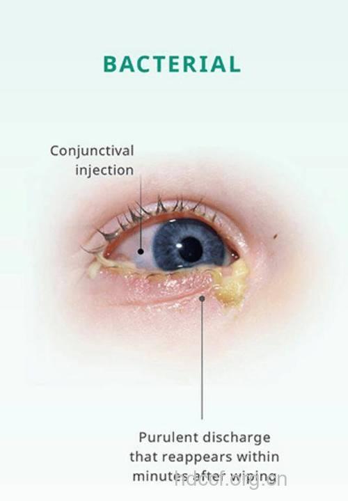 孩子眼睛有分泌物 妈咪这样做
