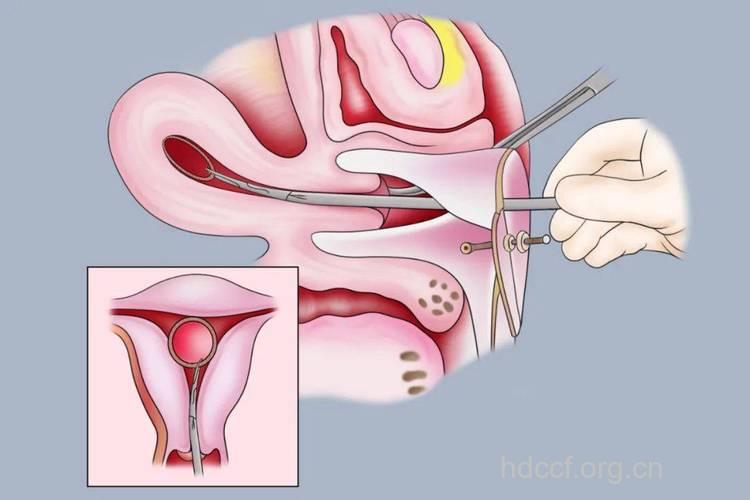 取环过程到底是怎样？女性取环全过程介绍